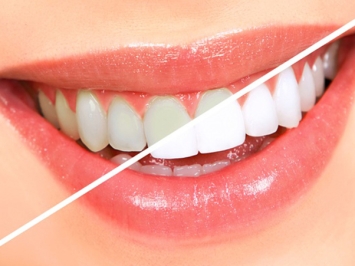 Mách bạn 7 cách làm trắng răng bằng chanh ngay tại nhà