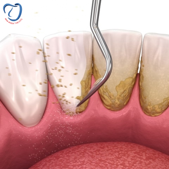 XỬ LÝ TÌNH TRẠNG VÔI RĂNG NHIỀU