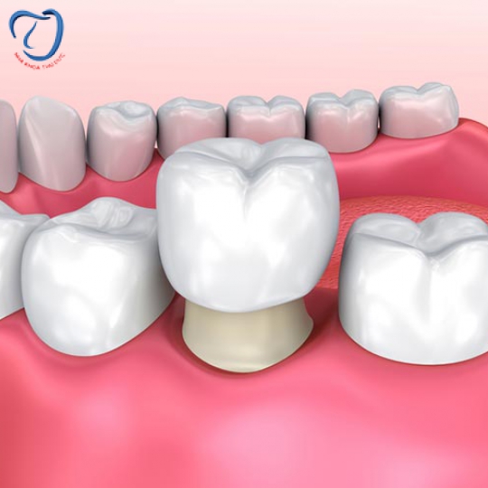 PHỤC HÌNH RĂNG SỨ TITAN