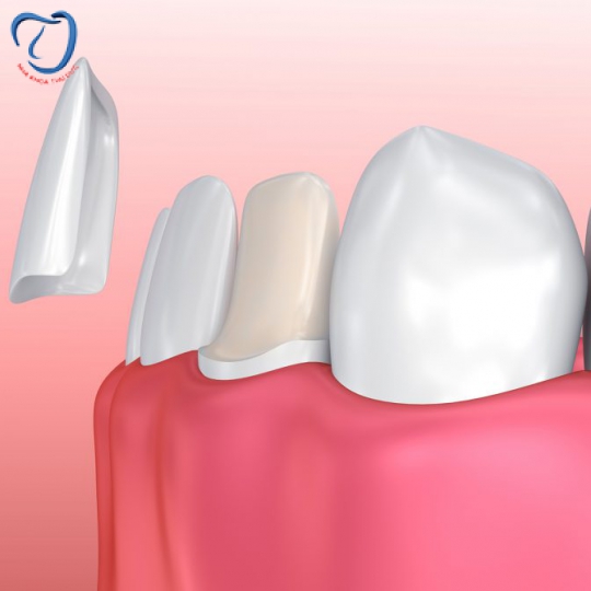 DÁN RĂNG SỨ VENEER 