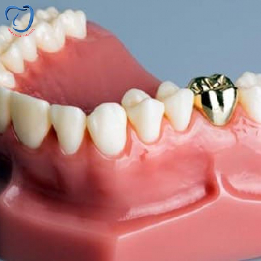 PHỤC HÌNH RĂNG SỨ KIM LOẠI 