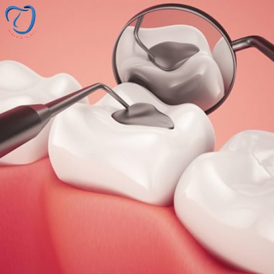 TRÁM RĂNG CHO TRẺ EM